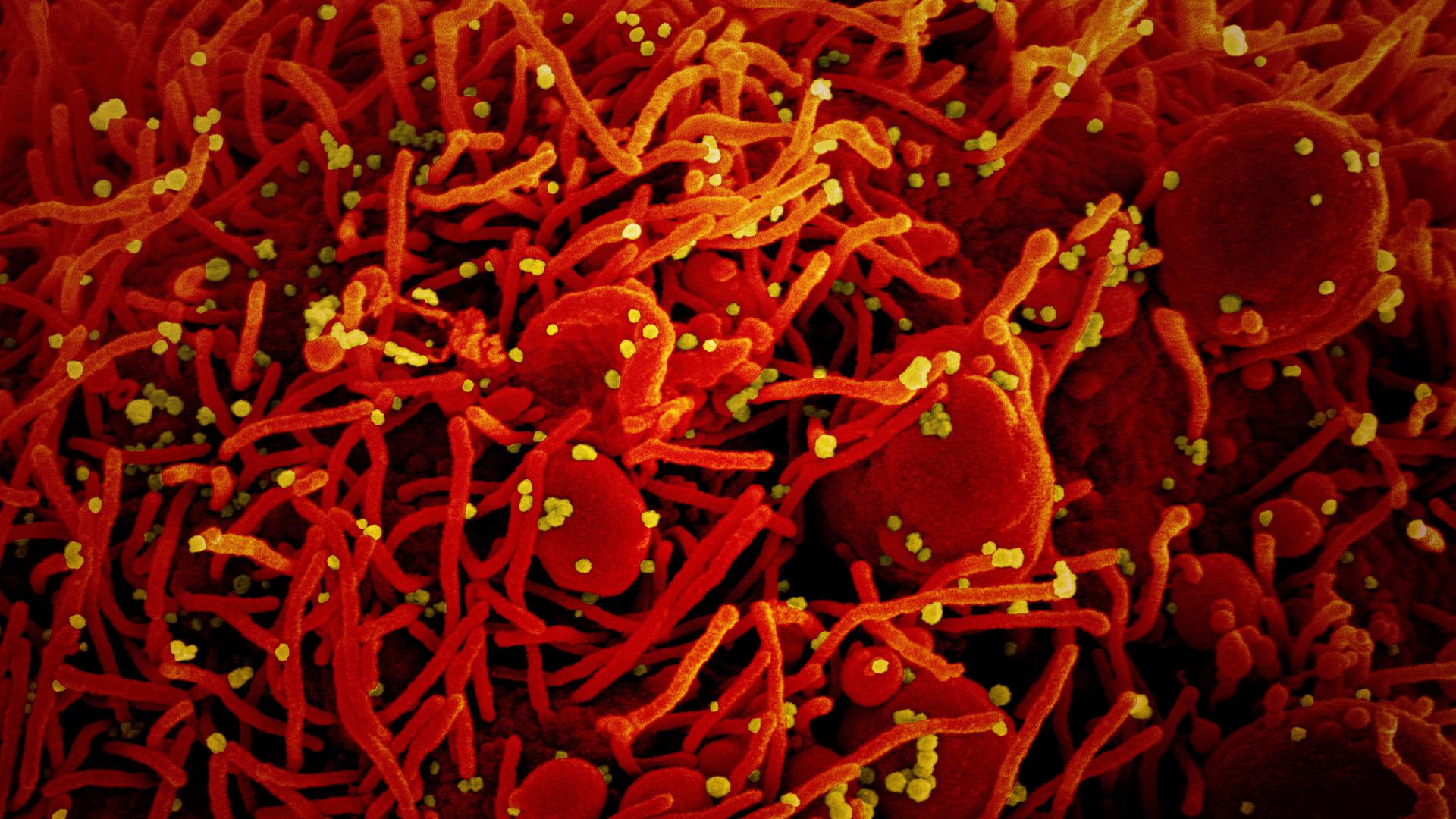 Eine Zelle (rot) mit dem Coronavirus (SARS-CoV-2, gelb) infiziert.