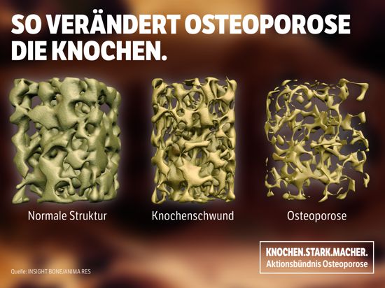 Kampagne für Knochengesundheit: Das Aktionsbündnis Osteoporose will mehr Aufmerksamkeit für die Krankheit. Foto: