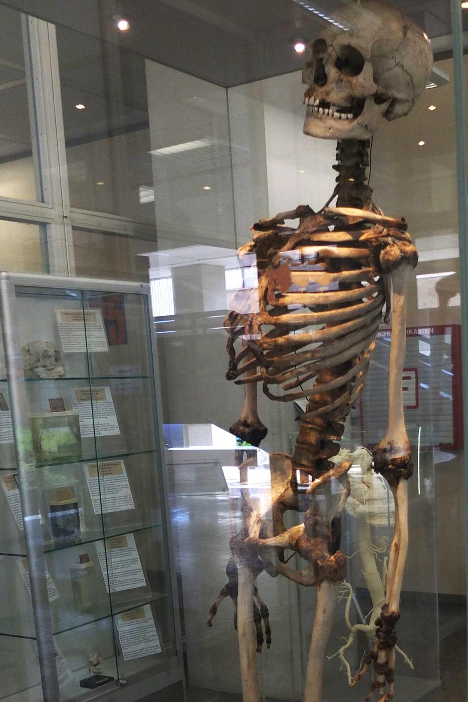 In der anatomischen Sammlung der Universität Heidelberg ist auch das mögliche Skelett des Schinderhannes zu sehen.