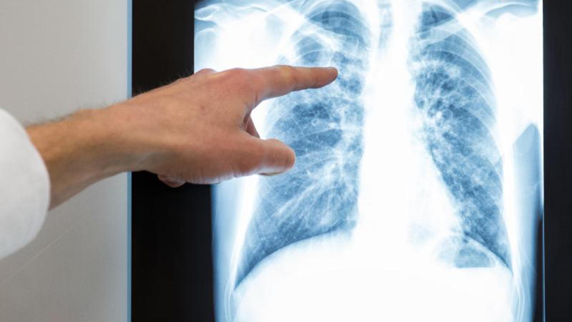 Ein Arzt zeigt auf das Röntgenbild einer Lunge