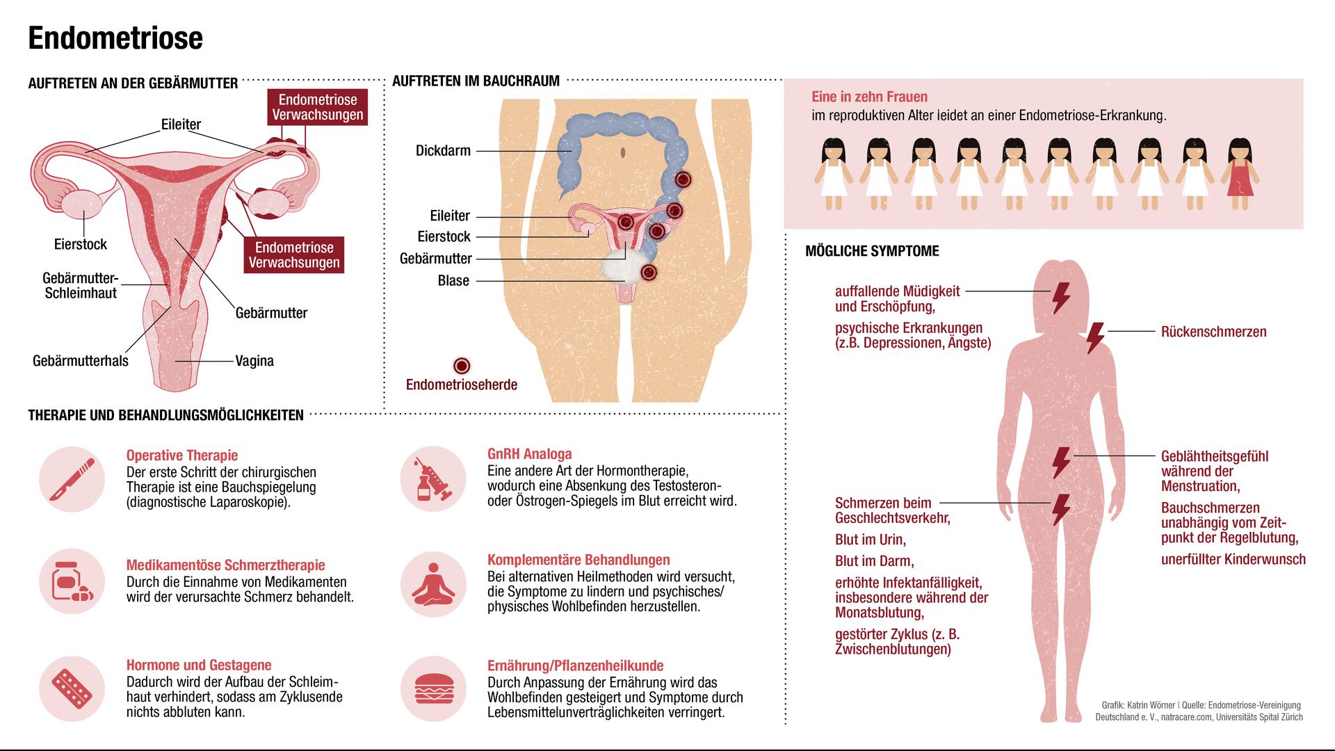 Infografik zum Thema Endometriose