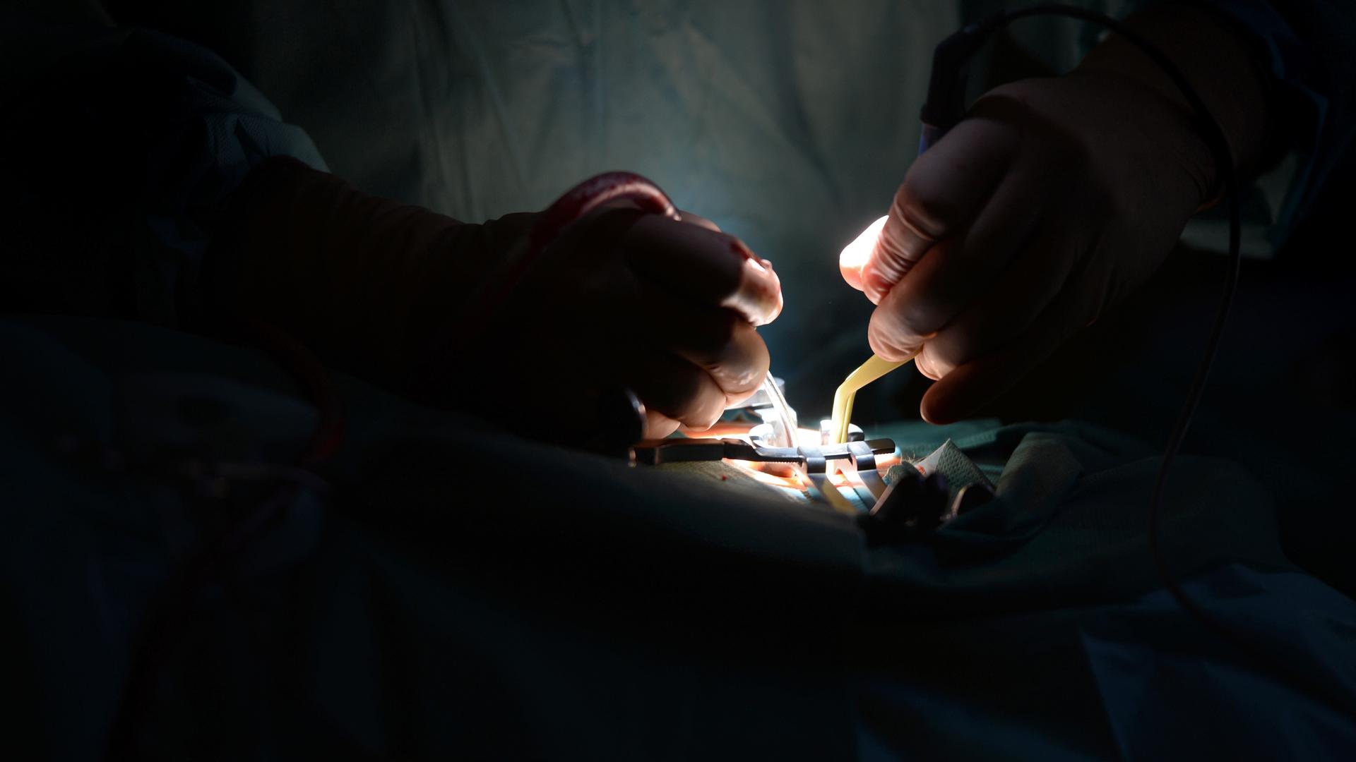 Ein Mediziner arbeitet in einer Klinik während einer Bandscheibenoperation an der Lendenwirbelsäule mit medizinischem Werkzeug. 