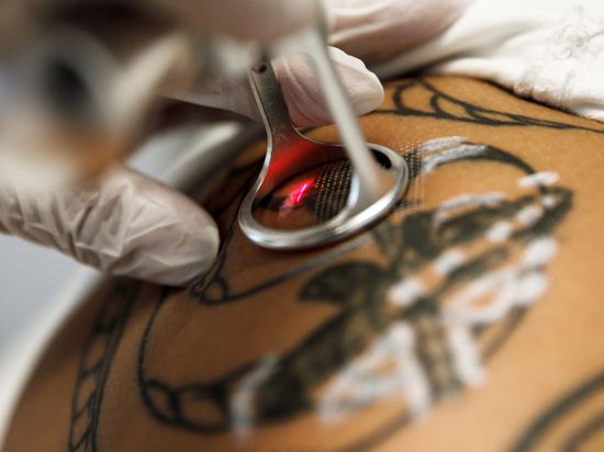 Ein Tattoo wird per Laser entfernt.