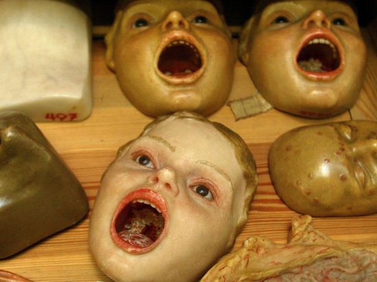 Wachsmodelle eines an Diphtherie erkrankten Kinds mit weit aufgerissenem Mund im Dresdner Hygiene-Museum