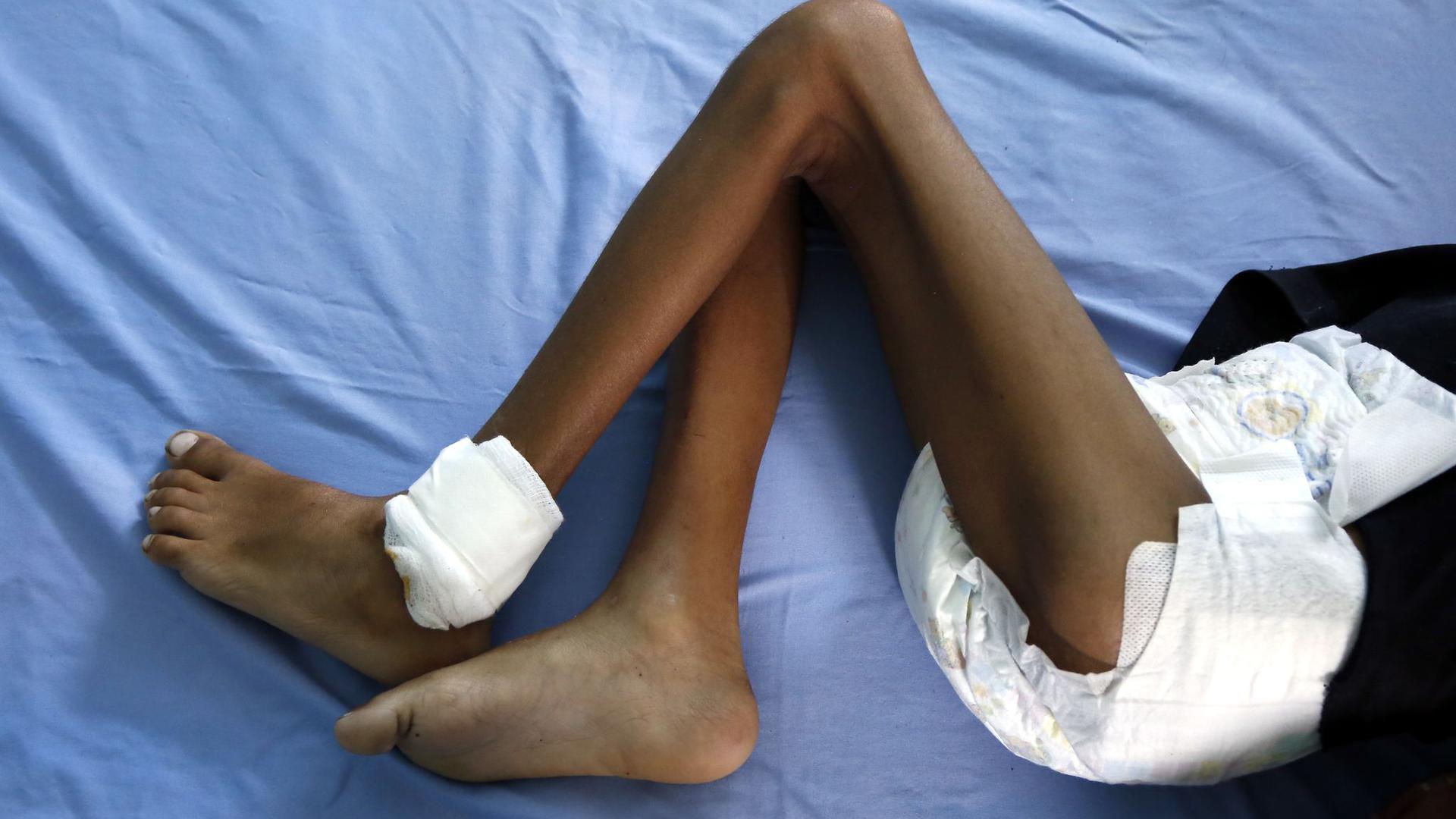 Ein unterernährtes Kind liegt in einem Krankenhaus im jemenitischen Hudaida.