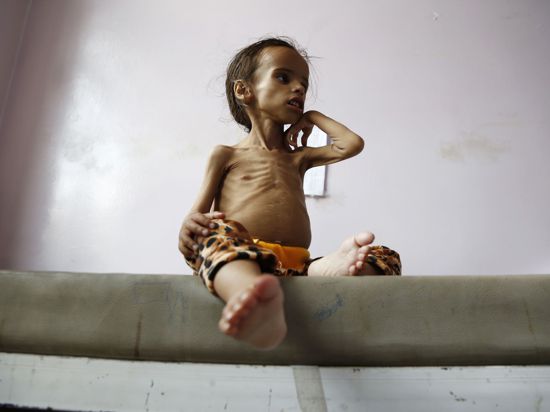 Ein unterernährtes Mädchen Bett in einem Krankenhaus in Jemens Hauptstadt Sanaa. Das Land im Süden der Arabischen Halbinsel wird im Report in die Kategorie „Katastrophe“ eingeordnet.