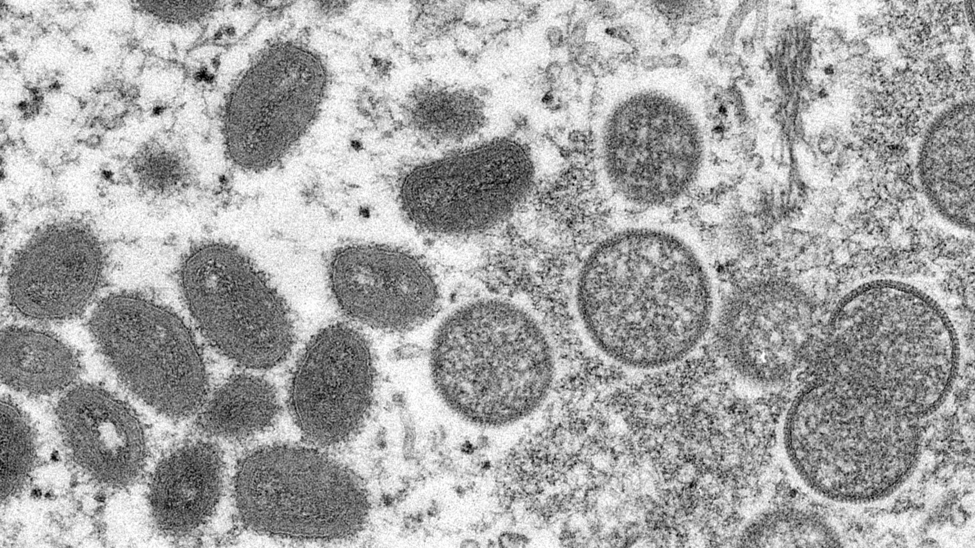 Diese elektronenmikroskopische Aufnahme zeigt reife, ovale Affenpockenviren (l) und kugelförmige unreife Virionen (r), die aus einer menschlichen Hautprobe stammen.