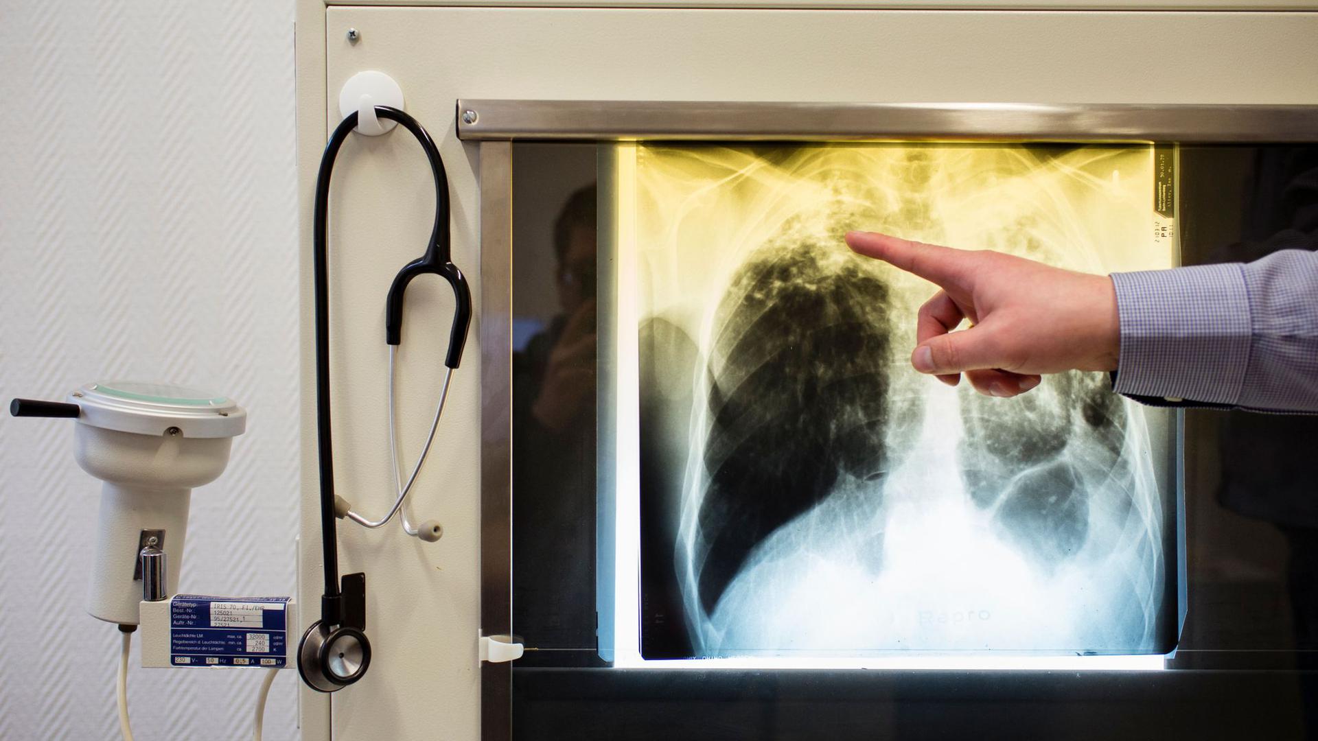 Ein Arzt zeigt einen Tuberkulose-Fall anhand eines Röntgenbildes im Tuberkulosezentrum in Berlin.