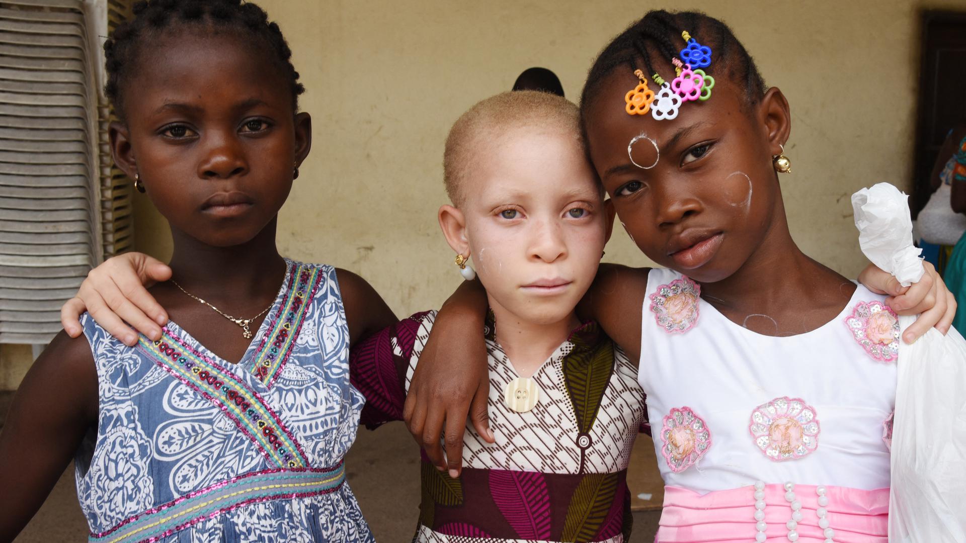 Opfer von Aberglauben: In einigen Regionen Afrikas werden gelegentlich Albino-Kinder entführt oder verstümmelt, weil ihre Gliedmaßen als Bestandteile einer angeblichen „Zaubermedizin“ Wunder bewirken und Glück bringen sollen. 